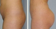 augmentation fesses tunisie