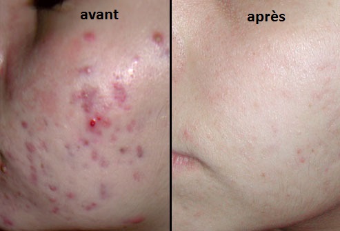 Acne littekenbehandeling België