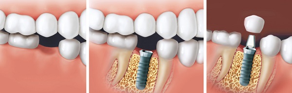 tandheelkundige implantaten België