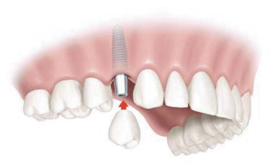 tandheelkundige implantatie België