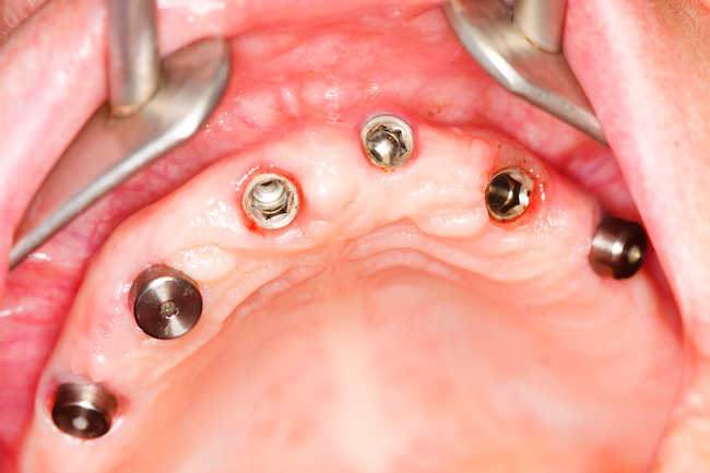 voorbereiding tandheelkundige implantaten België