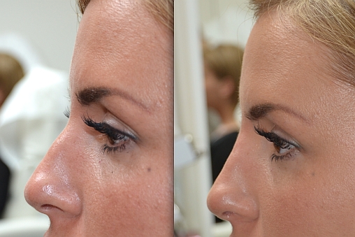 rhinoplastie esthetique belgique