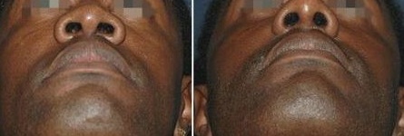 rhinoplastie belgique