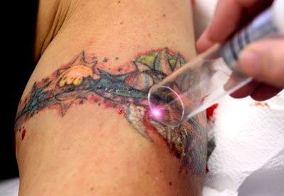 laser tattoo verwijdering tunesië