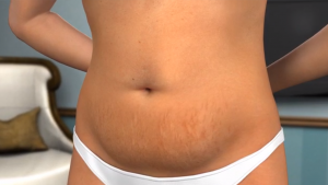 abdominoplastie