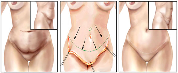 deroulement-abdominoplastie