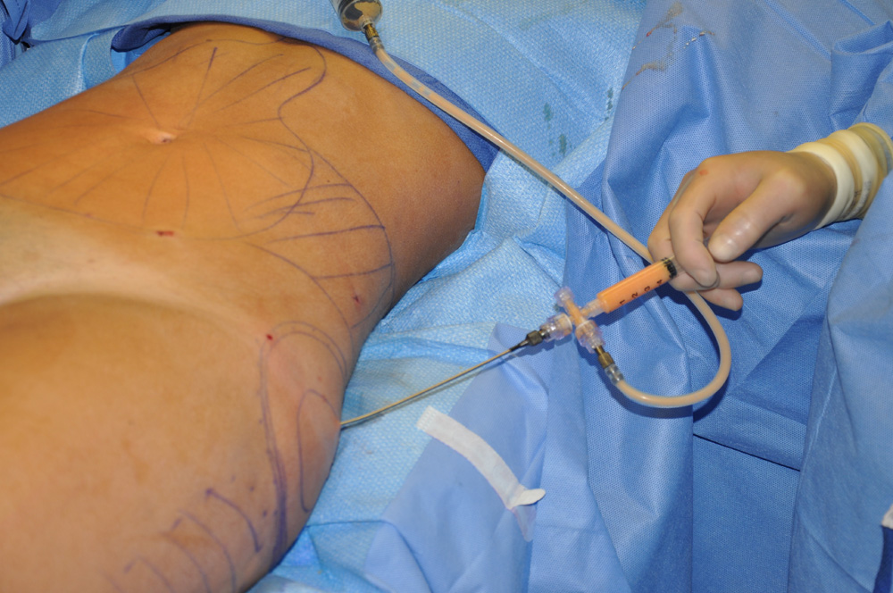 lipofilling-fesses