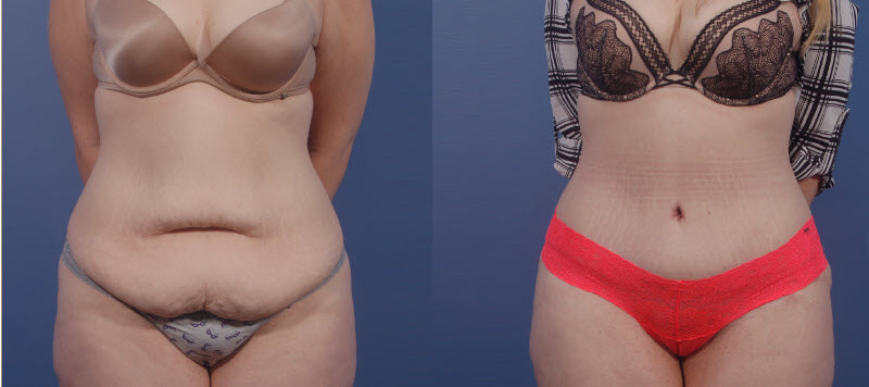 resultaat-voor-na-abdominoplastiek