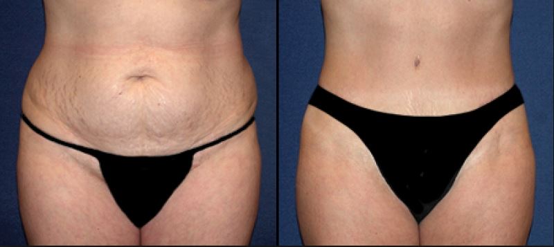 resultaat-mini-abdominoplastiek