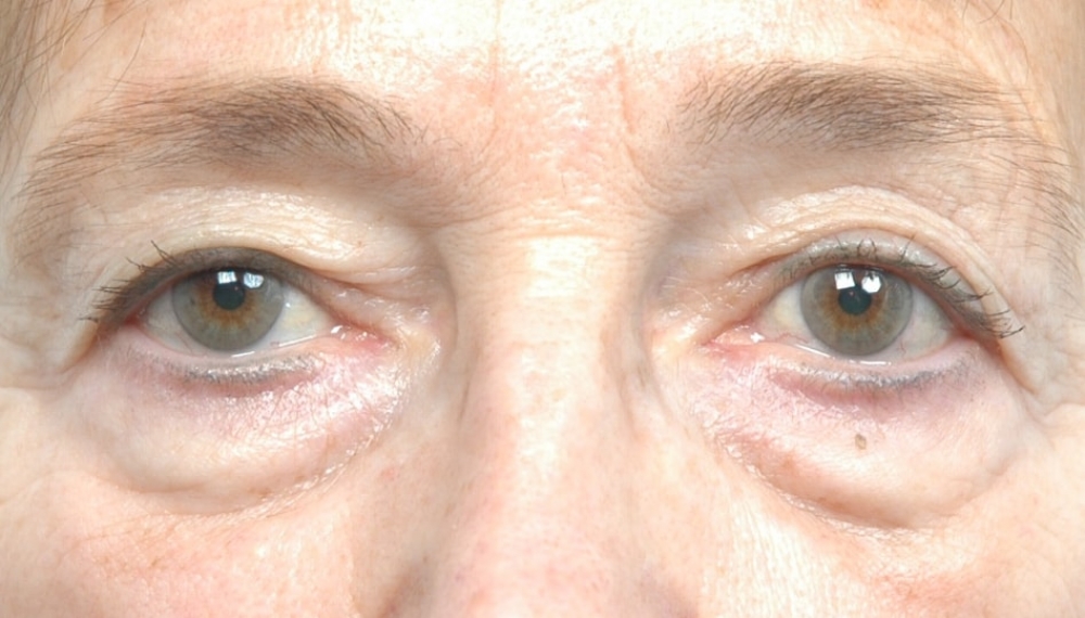 blepharoplastie-chirurgie-paupieres