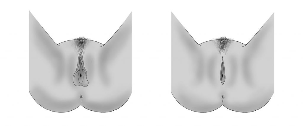 labioplastie-reduction-petites-levres