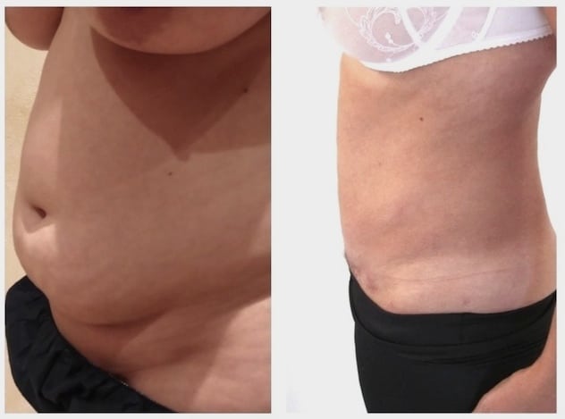 abdominoplastie circulaire prix