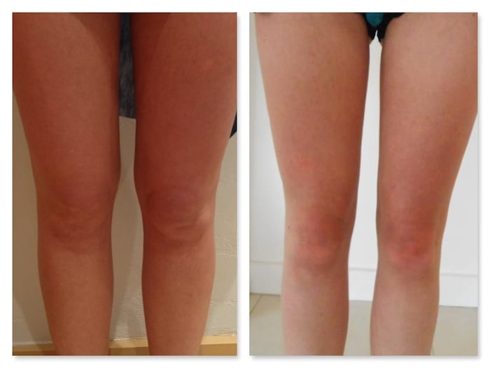 resultat liposuccion genoux