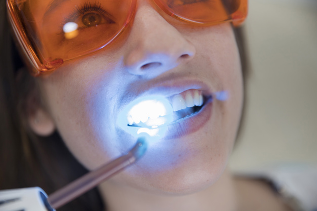 whitening-teeth-bij-laser-prijs-belgië