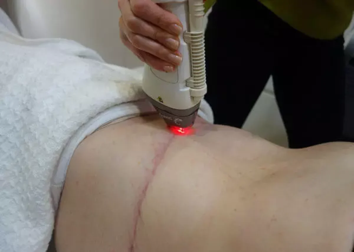 Laser pour éliminer les cicatrices après une abdominoplastie