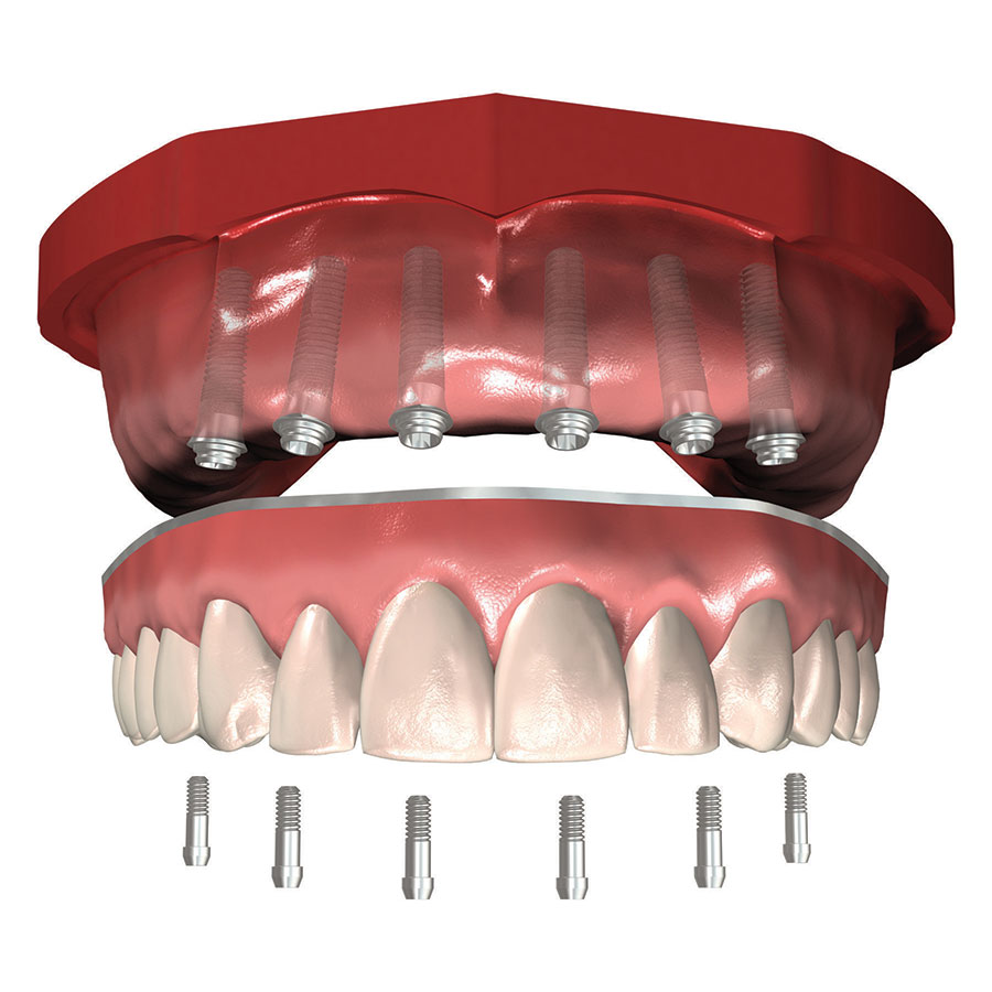 prix-implants-dentaires-machoire-complete