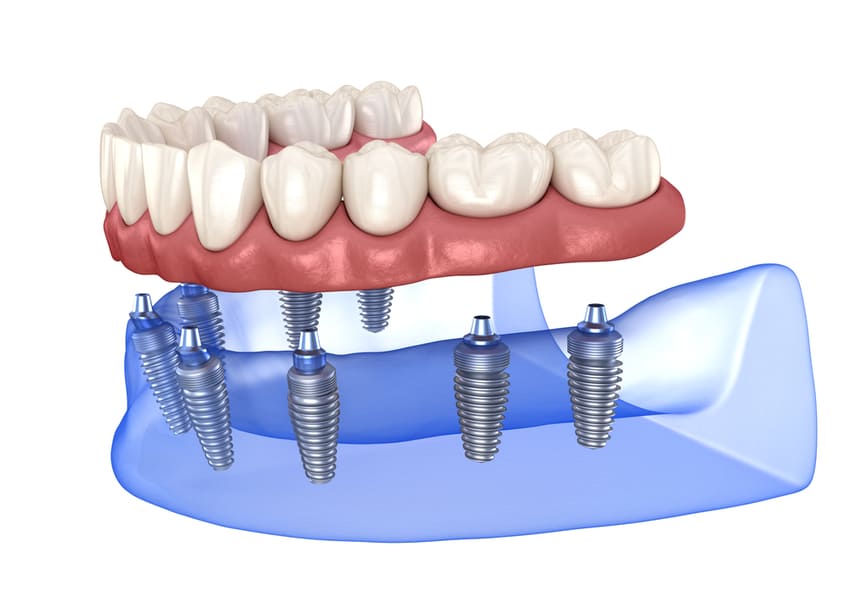 implants-dentaires-machoire-complete-belgique