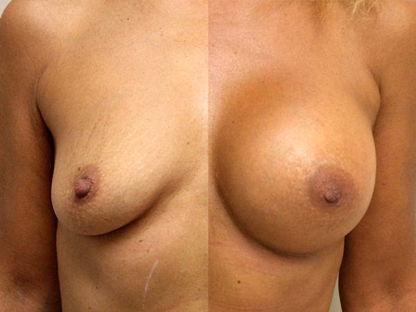BreastTite-lipofilling-seins-remodelage-mammaire